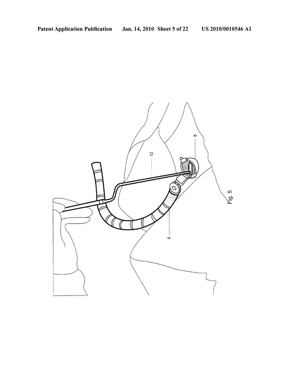 Minimally Invasive Instruments and Methods for the Micro Endoscopic Application of Spine Stabilizers in the Interspinous Space - diagram, schematic, and image 06