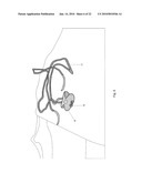 Minimally Invasive Instruments and Methods for the Micro Endoscopic Application of Spine Stabilizers in the Interspinous Space diagram and image