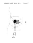 Minimally Invasive Instruments and Methods for the Micro Endoscopic Application of Spine Stabilizers in the Interspinous Space diagram and image