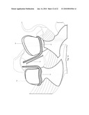 Minimally Invasive Instruments and Methods for the Micro Endoscopic Application of Spine Stabilizers in the Interspinous Space diagram and image