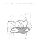 Minimally Invasive Instruments and Methods for the Micro Endoscopic Application of Spine Stabilizers in the Interspinous Space diagram and image