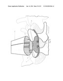 Minimally Invasive Instruments and Methods for the Micro Endoscopic Application of Spine Stabilizers in the Interspinous Space diagram and image