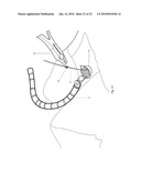 Minimally Invasive Instruments and Methods for the Micro Endoscopic Application of Spine Stabilizers in the Interspinous Space diagram and image