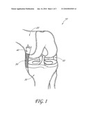  DEVICE AND METHOD OF MINIMALLY INVASIVE EXTRACAPSULAR LIGAMENTOUS AUGMENTATION FOR CANINE STIFLE LIGAMENT INJURIES diagram and image