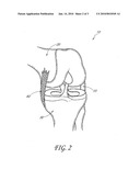  DEVICE AND METHOD OF MINIMALLY INVASIVE EXTRACAPSULAR LIGAMENTOUS AUGMENTATION FOR CANINE STIFLE LIGAMENT INJURIES diagram and image