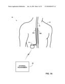 PATIENT-DEFINED POSTURE STATES FOR POSTURE RESPONSIVE THERAPY diagram and image