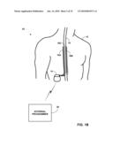 PATIENT-DEFINED POSTURE STATES FOR POSTURE RESPONSIVE THERAPY diagram and image