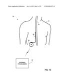 PATIENT-DEFINED POSTURE STATES FOR POSTURE RESPONSIVE THERAPY diagram and image