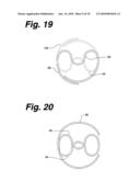 ANASTOMOSIS STENT AND GRAFT APPARATUS AND METHOD diagram and image