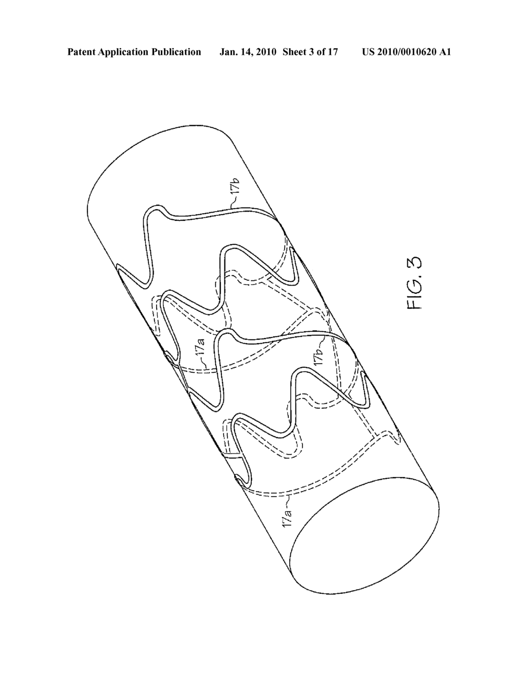 Stent - diagram, schematic, and image 04