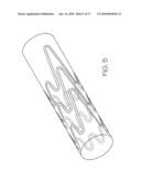 Stent diagram and image