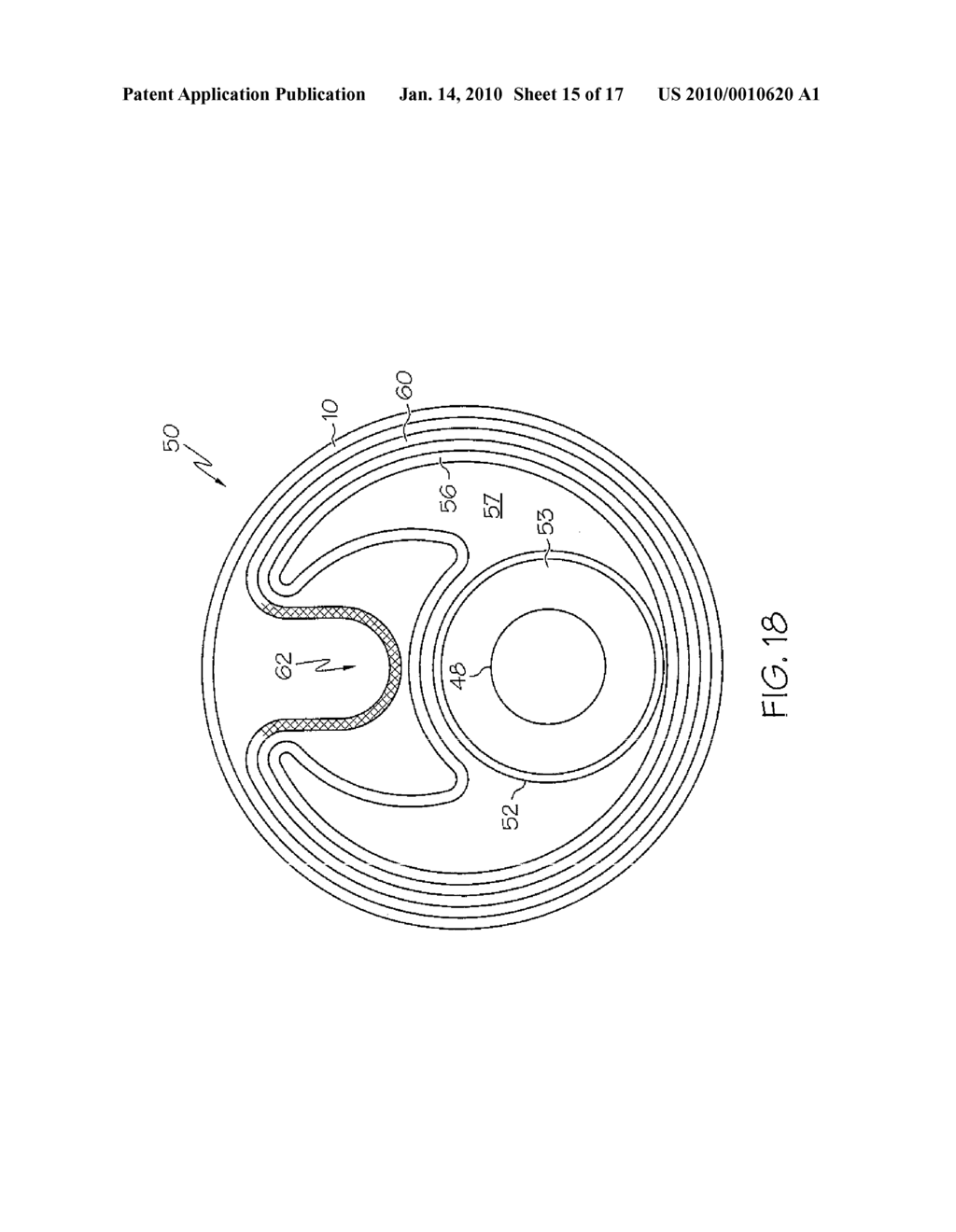 Stent - diagram, schematic, and image 16