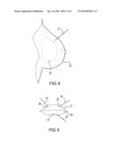 Breast Implants and Compositions of Extracellular Matrix diagram and image