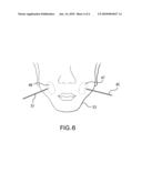 Breast Implants and Compositions of Extracellular Matrix diagram and image