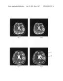 METHODS AND DEVICES FOR PRODUCING THE PARAMETERS OF THE BRAIN TISSUES AND ASSESSING DATA OF THE SUITABILITY FOR THROMBOLYSIS OF A PATIENT diagram and image