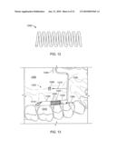 Orthodontic Devices diagram and image