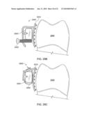 Orthodontic Devices diagram and image