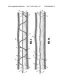 SPIRALLY CONFORMABLE INFUSION CATHETER diagram and image