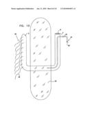 FLOATING GASTROINTESTINAL ANCHOR diagram and image