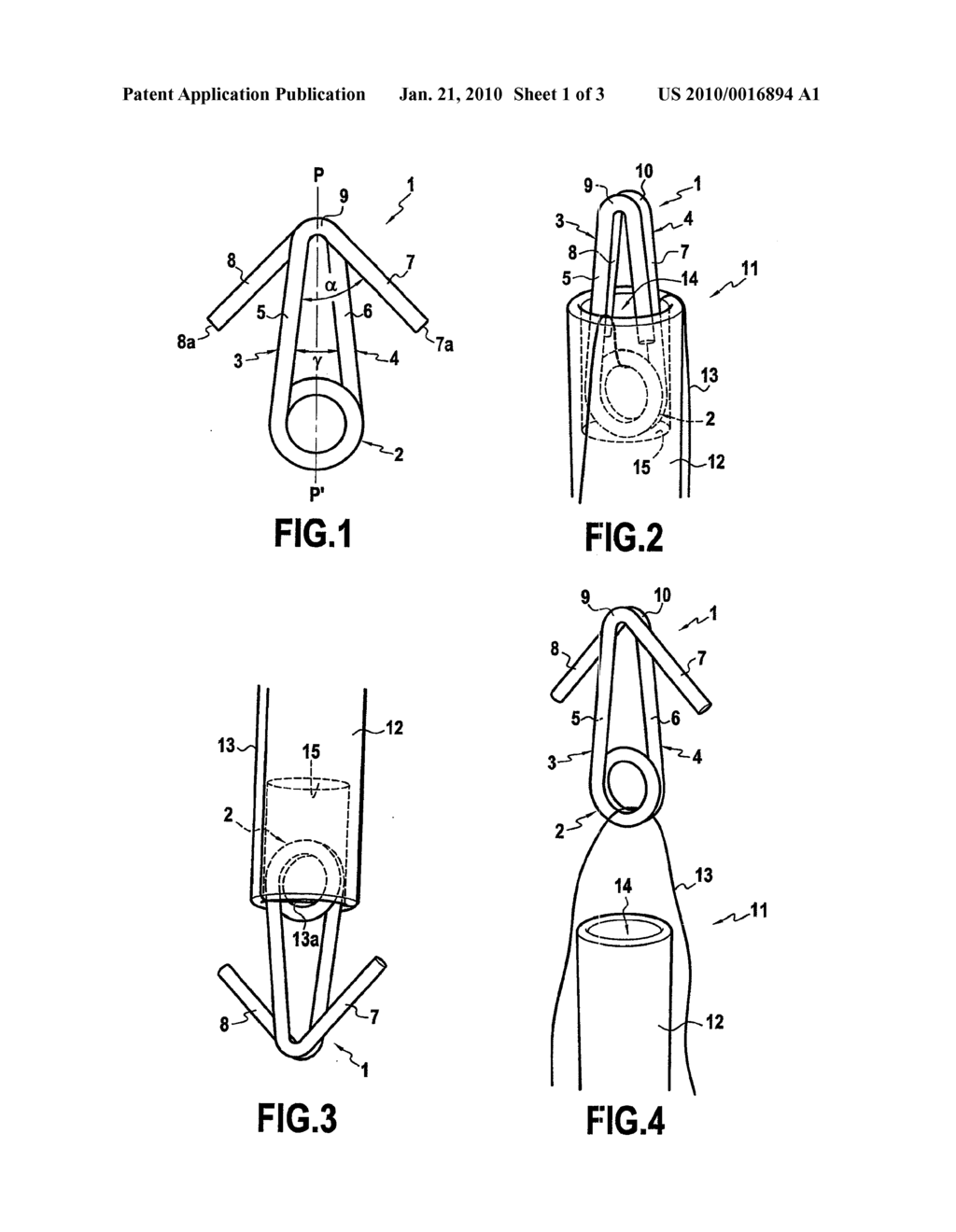 ANCHORING AND FIXING IMPLANT AND SURGICAL ASSEMBLY FOR ITS IMPLANTATION - diagram, schematic, and image 02