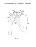 CLAVICLE FIXATION diagram and image