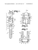 Upload shank swivel head bone screw spinal implant diagram and image