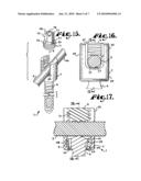 Upload shank swivel head bone screw spinal implant diagram and image