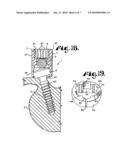 Upload shank swivel head bone screw spinal implant diagram and image