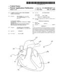 CARDIAC PACING USING THE INFERIOR NODAL EXTENSION diagram and image