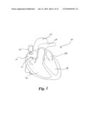 CARDIAC PACING USING THE INFERIOR NODAL EXTENSION diagram and image