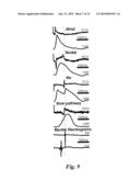 CARDIAC PACING USING THE INFERIOR NODAL EXTENSION diagram and image