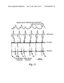 CARDIAC PACING USING THE INFERIOR NODAL EXTENSION diagram and image