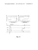 CARDIAC PACING USING THE INFERIOR NODAL EXTENSION diagram and image