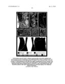 CARDIAC PACING USING THE INFERIOR NODAL EXTENSION diagram and image