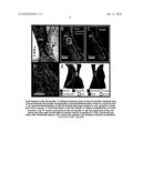 CARDIAC PACING USING THE INFERIOR NODAL EXTENSION diagram and image