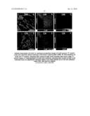 CARDIAC PACING USING THE INFERIOR NODAL EXTENSION diagram and image