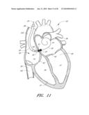 METHOD FOR DIGITAL CARDIAC RHYTHM MANAGEMENT diagram and image