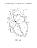 METHOD FOR DIGITAL CARDIAC RHYTHM MANAGEMENT diagram and image