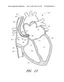 METHOD FOR DIGITAL CARDIAC RHYTHM MANAGEMENT diagram and image