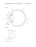 Intraocular Lens Assembly diagram and image