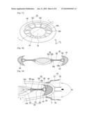 Intraocular Lens Assembly diagram and image