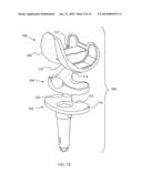 KNEE PROSTHESES WITH ENHANCED KINEMATICS diagram and image