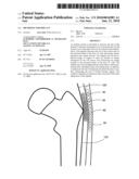 HIP PROTECTOR IMPLANT diagram and image