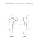 HIP PROTECTOR IMPLANT diagram and image