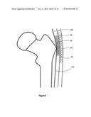 HIP PROTECTOR IMPLANT diagram and image