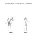 HIP PROTECTOR IMPLANT diagram and image