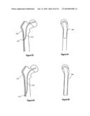 HIP PROTECTOR IMPLANT diagram and image