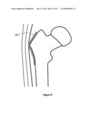 HIP PROTECTOR IMPLANT diagram and image