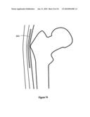 HIP PROTECTOR IMPLANT diagram and image