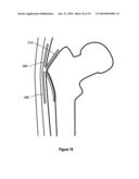 HIP PROTECTOR IMPLANT diagram and image